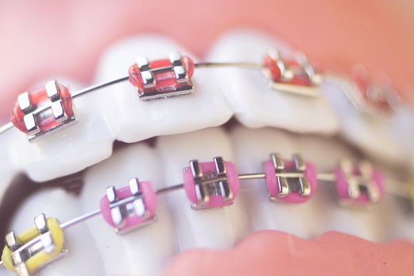 Élastique Orthodontiques, Orthodontiques, Élastiques Multifonction